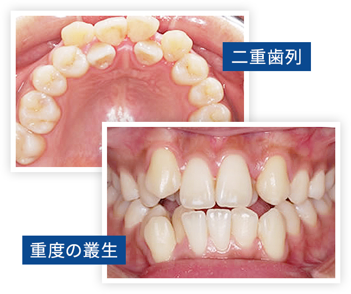 二重歯列、重度の叢生