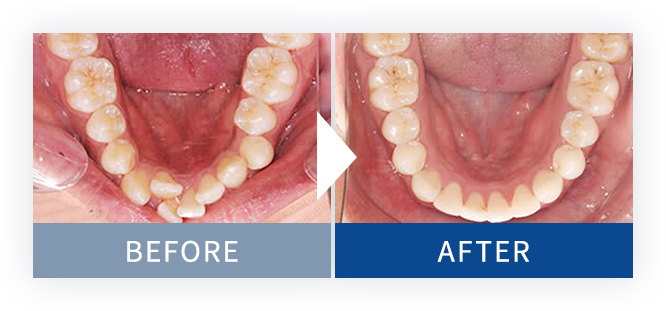 裏側矯正Brava症例1