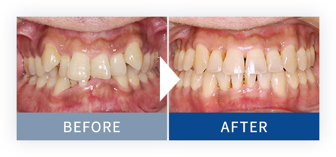 裏側矯正Brava症例2