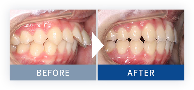 裏側矯正Brava症例3