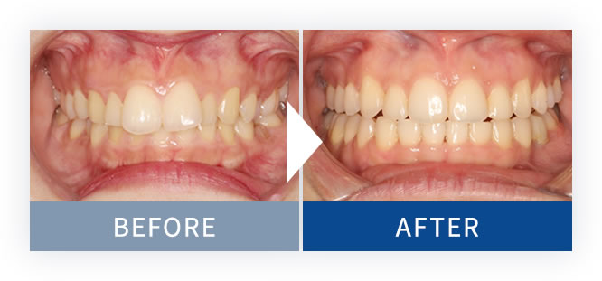 裏側矯正Brava症例2