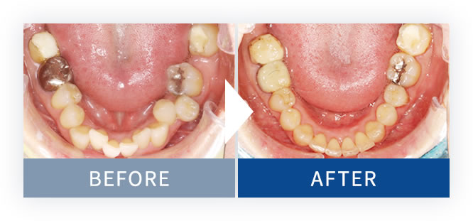 裏側矯正Brava症例1