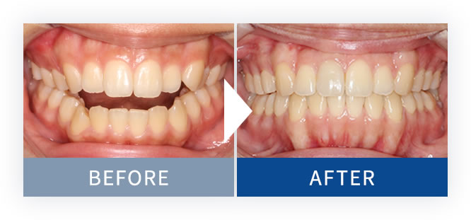 裏側矯正Brava症例3