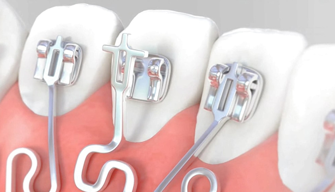 口腔ケアが簡単(フロスが通る)