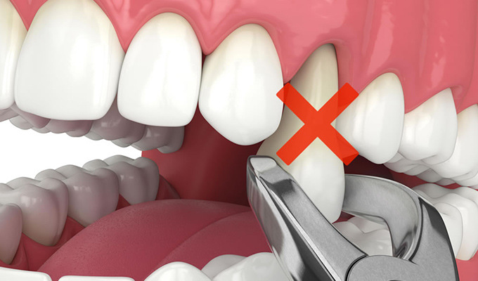 できるだけ歯を抜かない非抜歯矯正