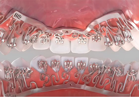 裏側矯正ブラーバの開始