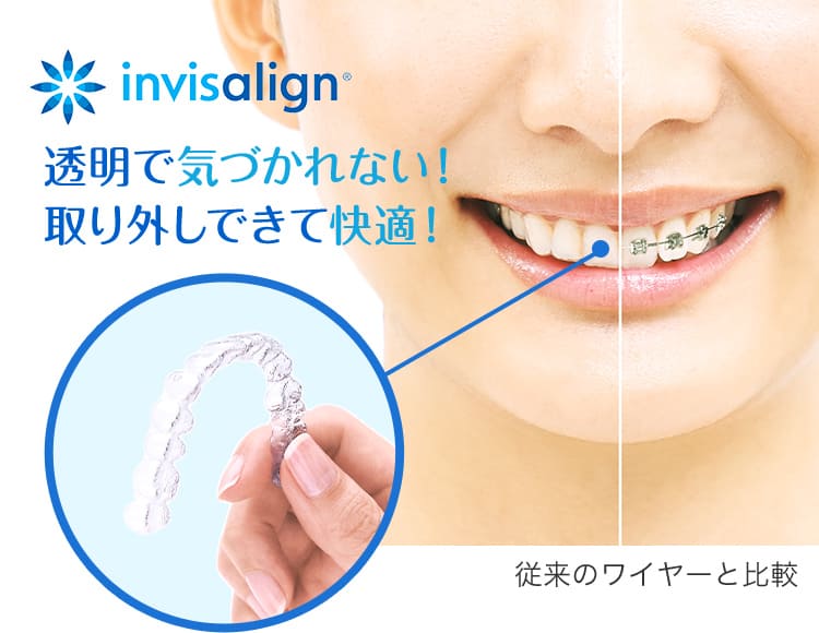 インビザラインとワイヤー矯正装置の比較画像