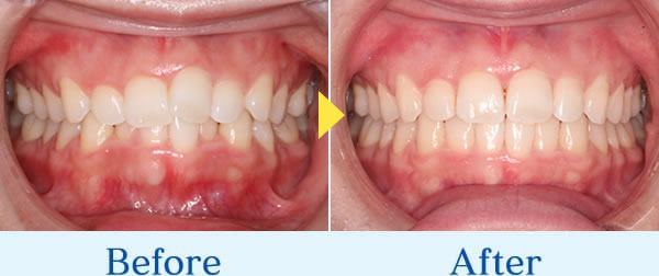 インビザライン症例1