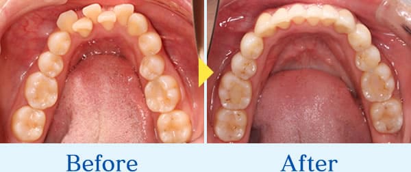 インビザライン症例2