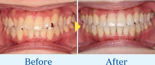 インビザライン症例3