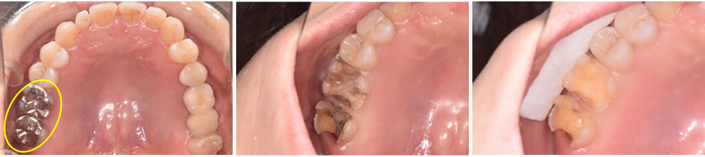 銀歯2次カリエス症例