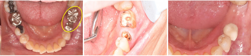 銀歯の2次カリエス症例(抜歯)