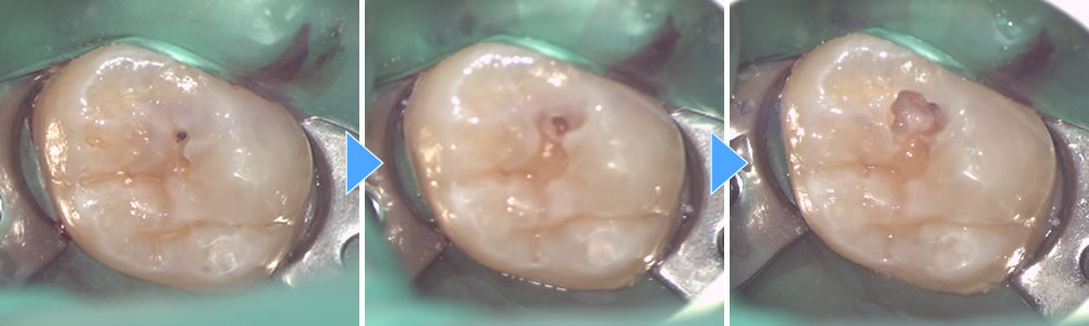 マイクロスコープとオゾンによる低侵襲虫歯治療の症例