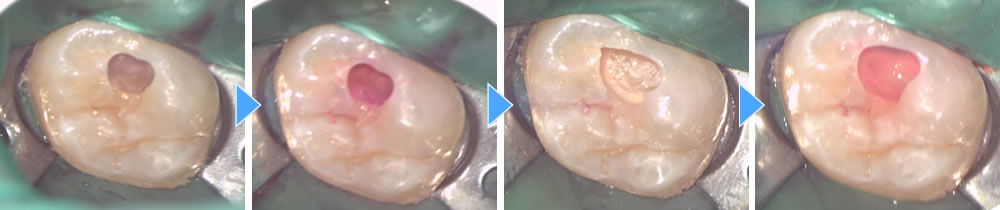 マイクロスコープとオゾンによる低侵襲虫歯治療の症例
