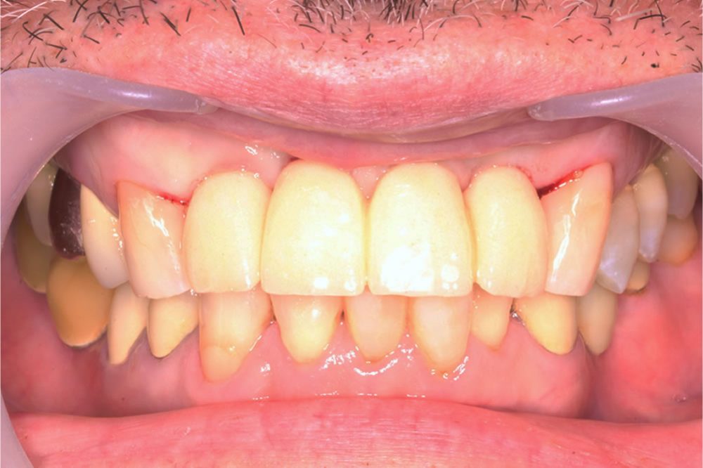 術後治癒期間中の仮歯の状態