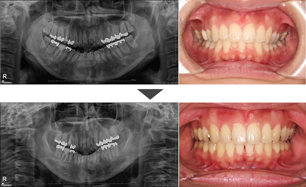 レントゲンと口腔内写真の比較