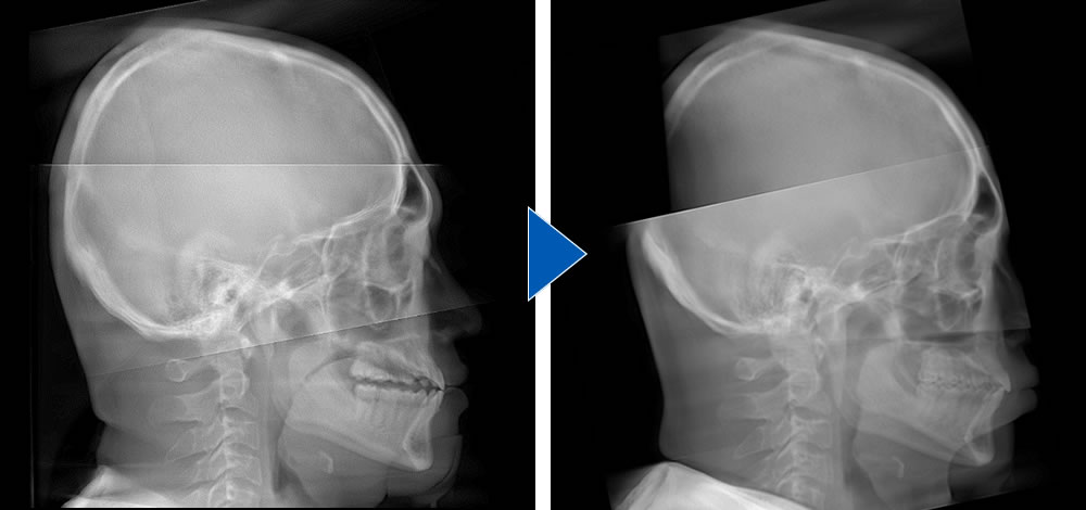 セファロレントゲンによる骨格の比較