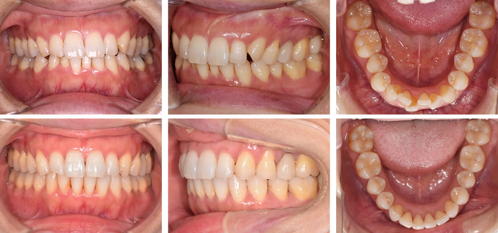「インビザライン」による矯正治療症例