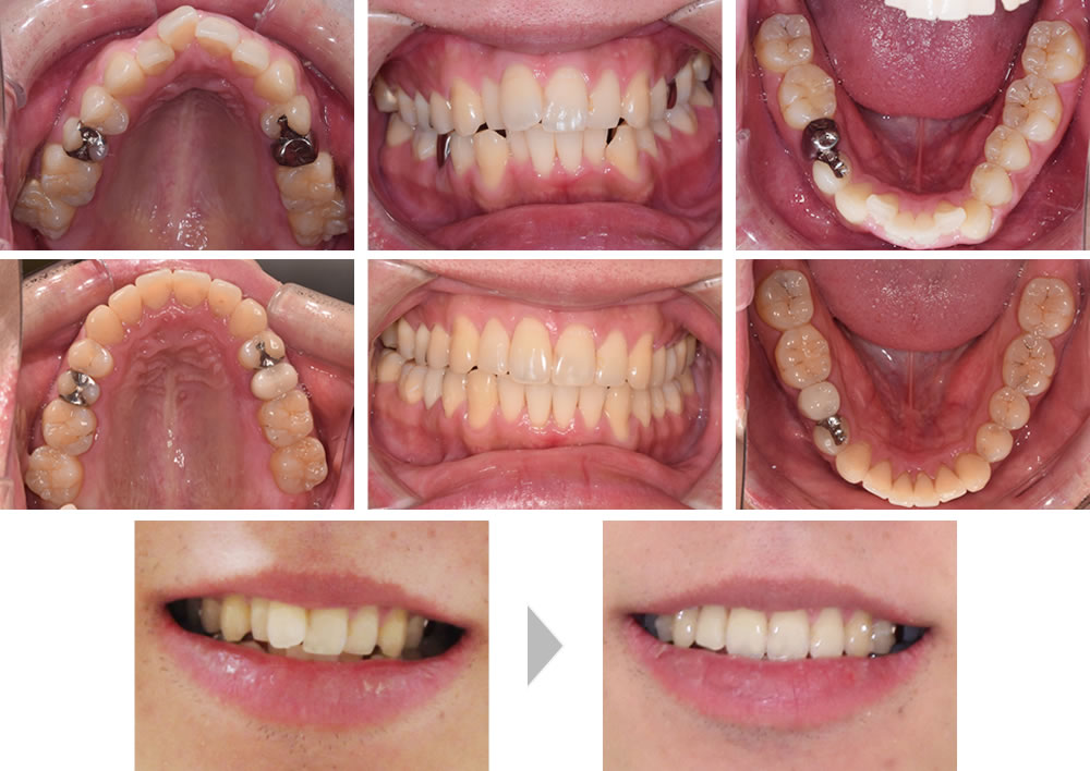 歯科矯正治療 銀座６丁目のぶデジタル歯科