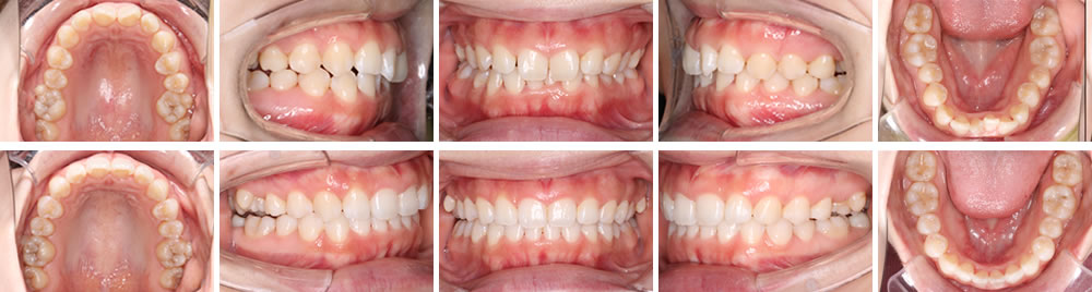 拡大床/マウスピース矯正による矯正治療症例