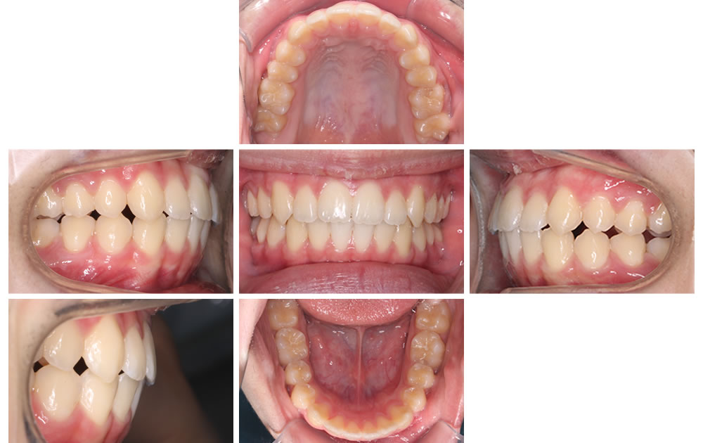 「インビザライン」による矯正治療症例
