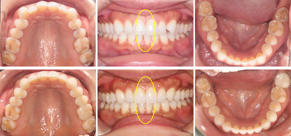 「インビザライン」による矯正治療症例