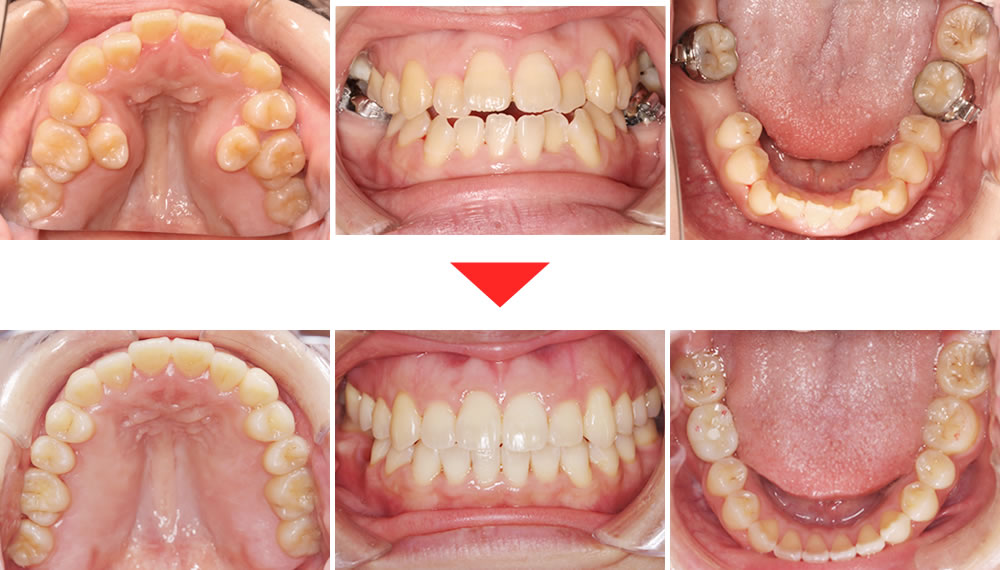 非抜歯拡大矯正とインプラント治療の症例