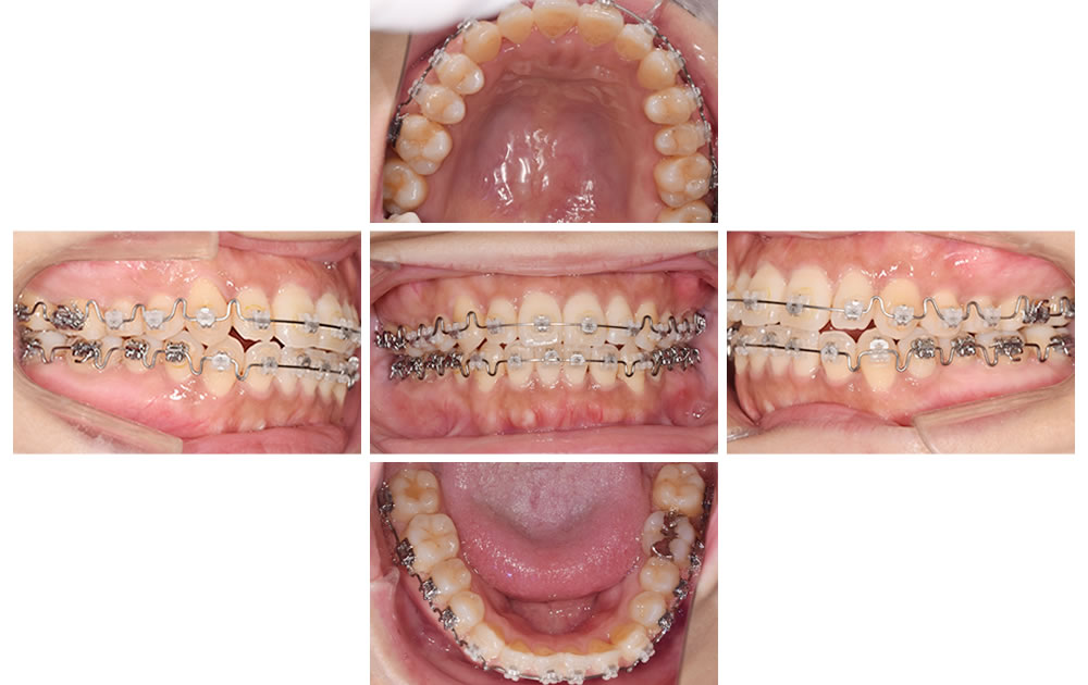 開咬と歯列の中心のズレを改善