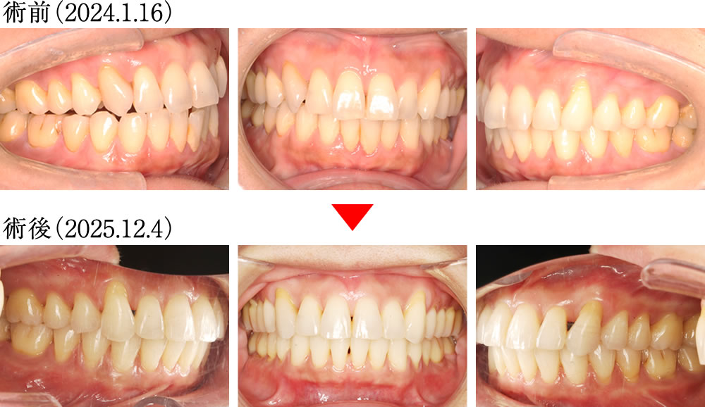 拡大床・ホワイトワイヤー矯正で歯並び・咬み合わせを改善した症例