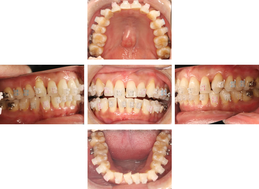 ホワイトブラケットワイヤー装置