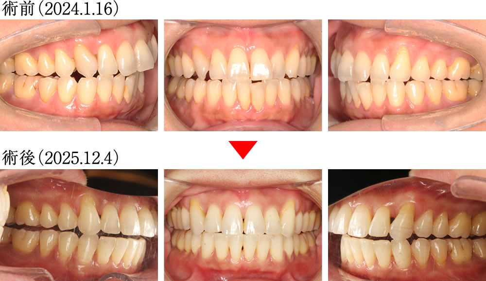 偏心運動の変化