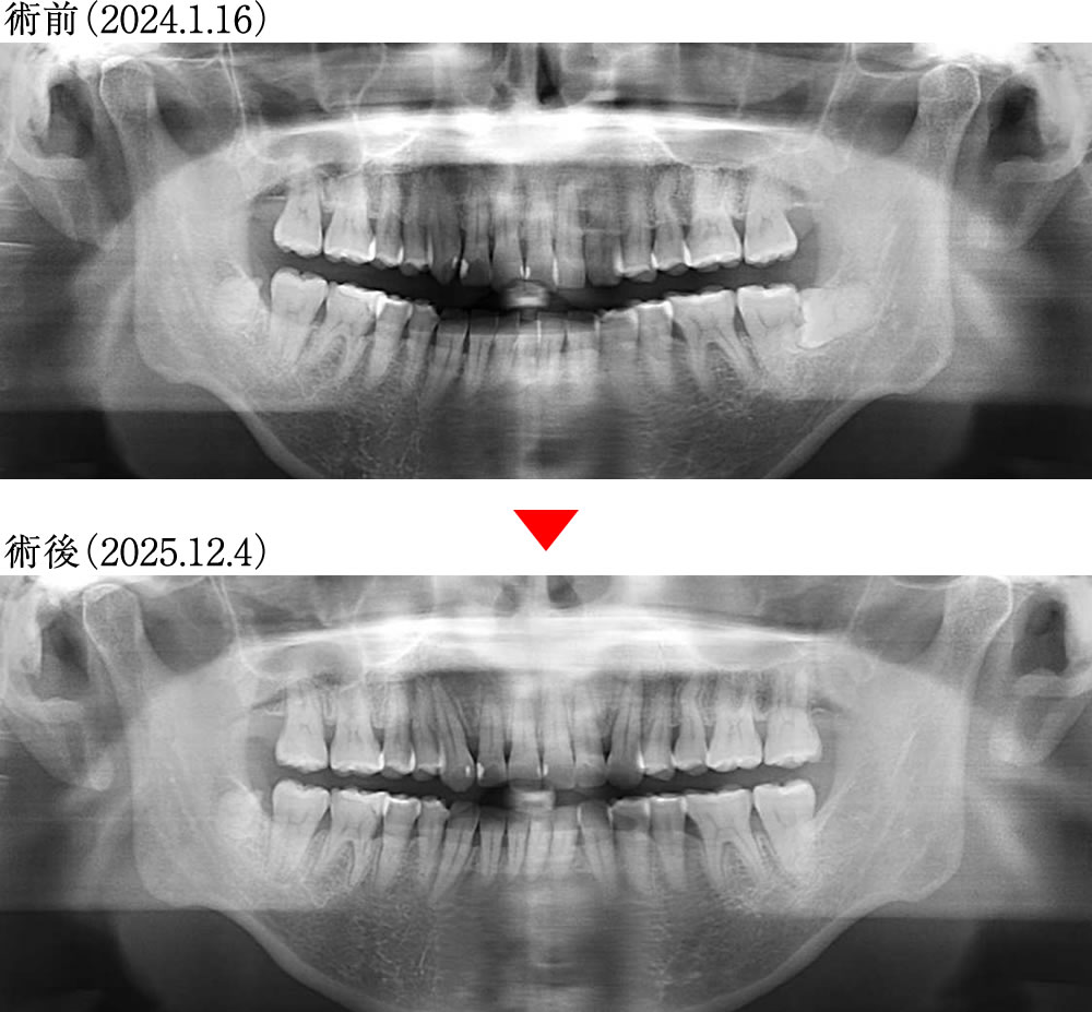 術前術後の骨格の変化