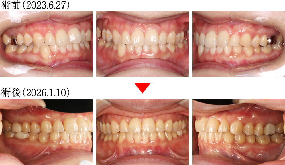 拡大床とワイヤー矯正で歯並びと咬み合わせを改善した症例