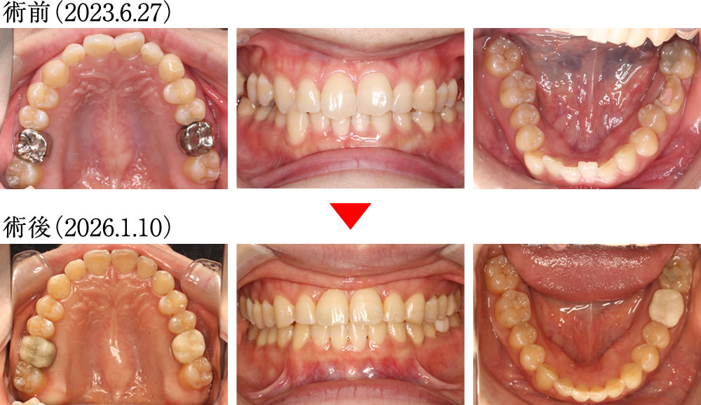 拡大床とワイヤー矯正で歯並びと咬み合わせを改善した症例