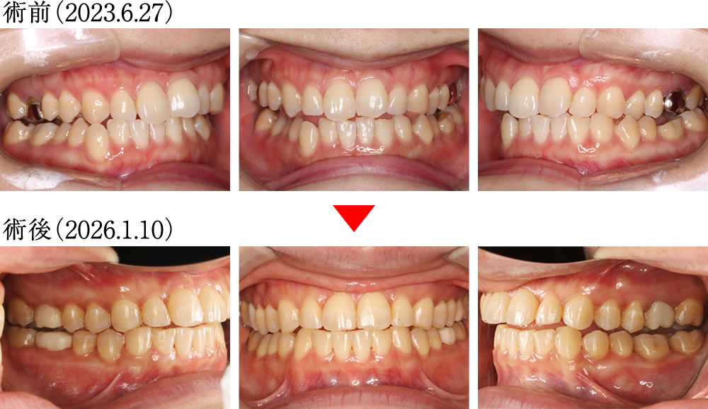 偏心運動の変化