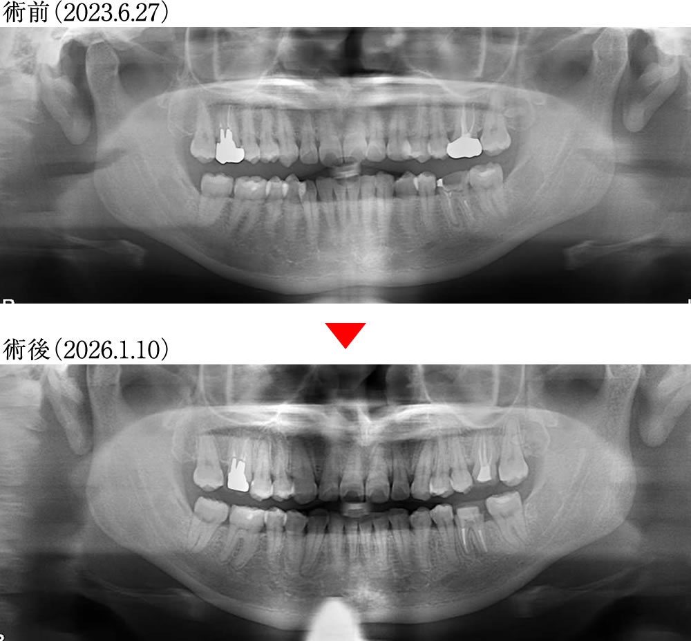 術前術後のレントゲン画像