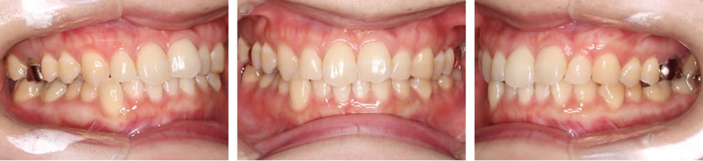 初診時の口腔内