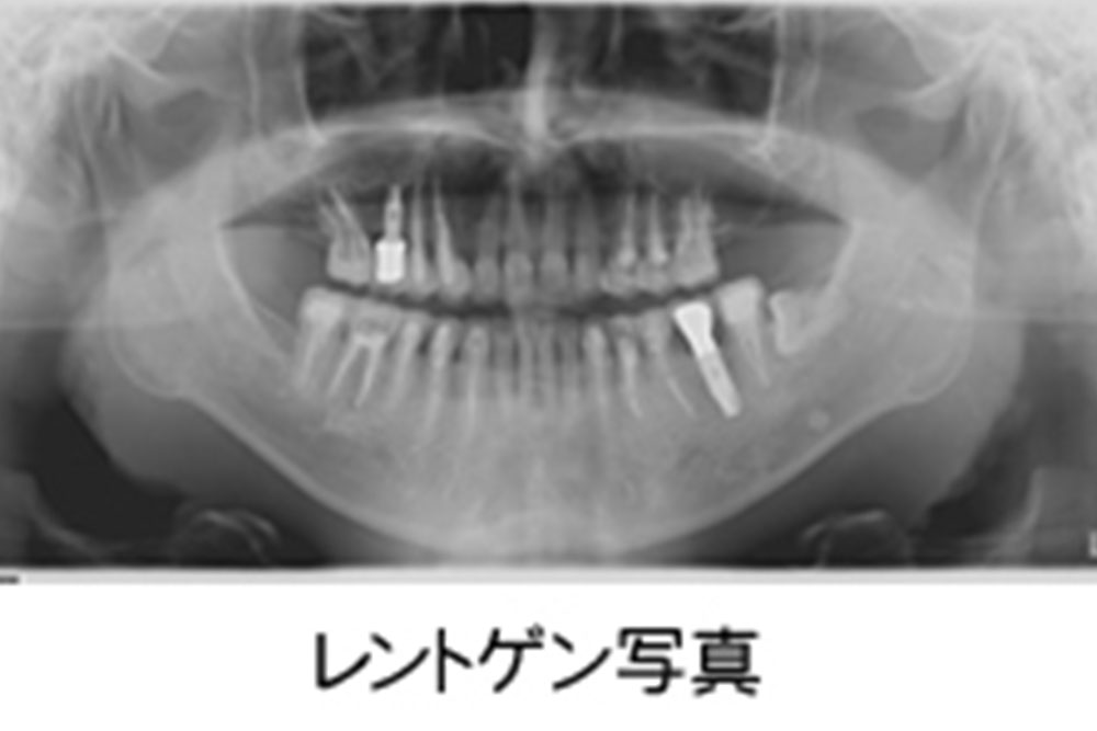 レントゲン