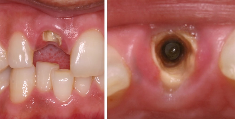歯ぐきの中に埋もれた歯根