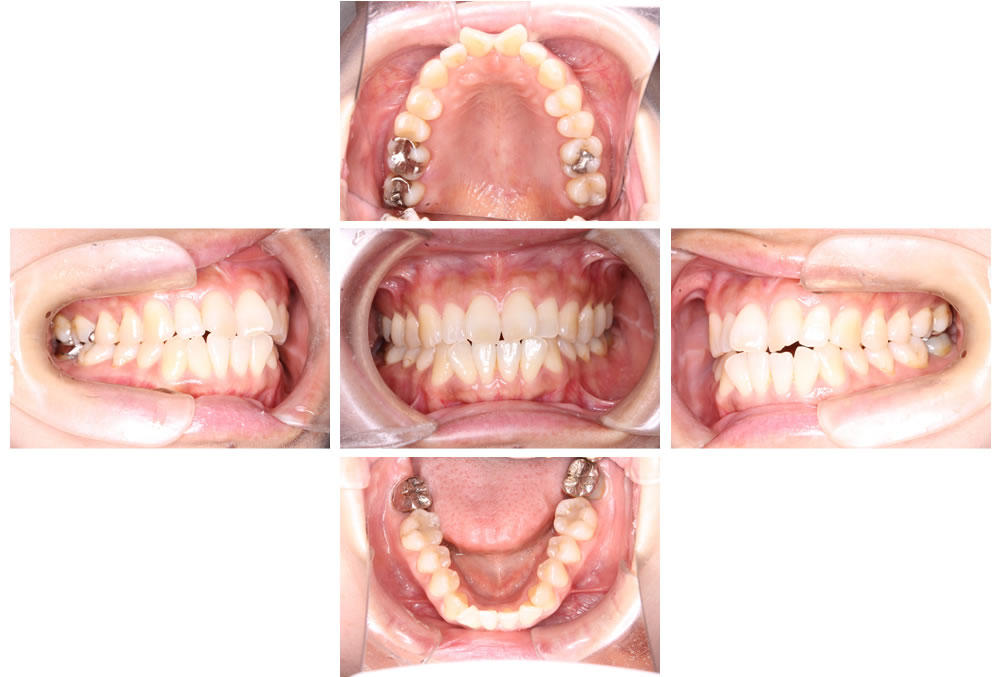 拡大3次元矯正症例初診時