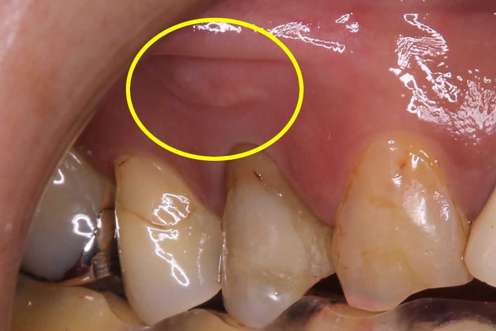 歯の根元の膨らみ