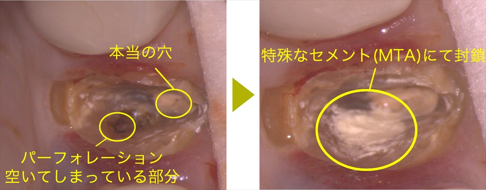 根管に空いてしまった穴