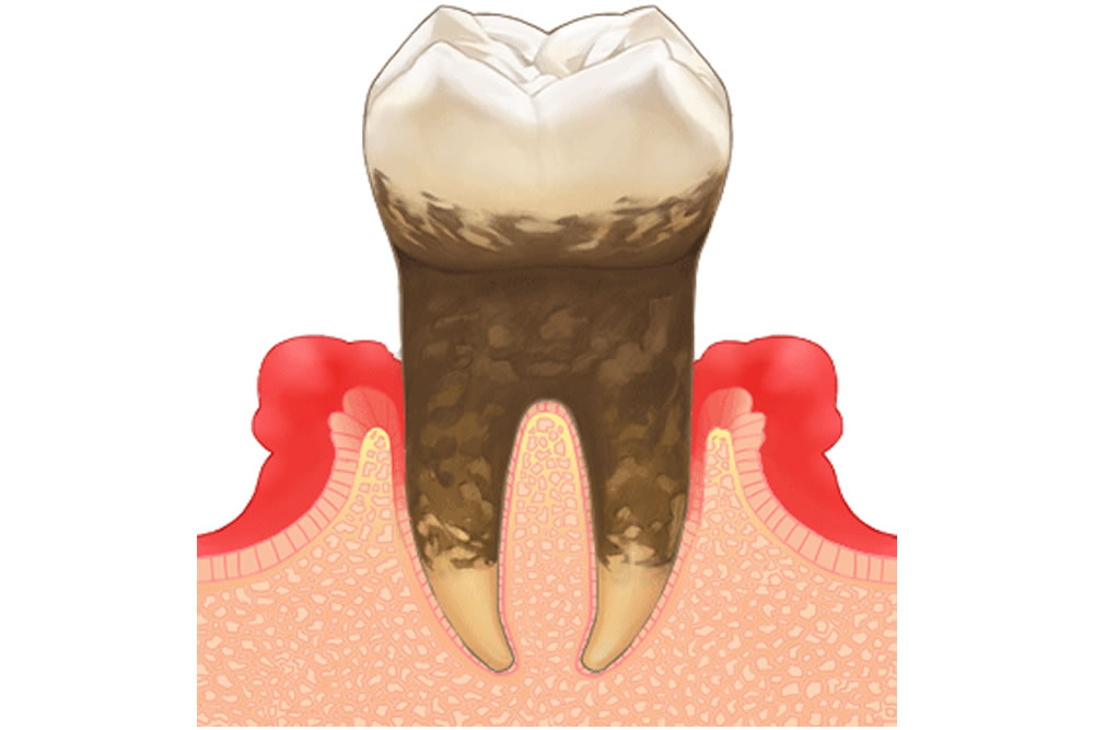 歯周再生療法