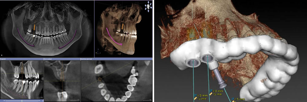 インプラント治療のデジタル化