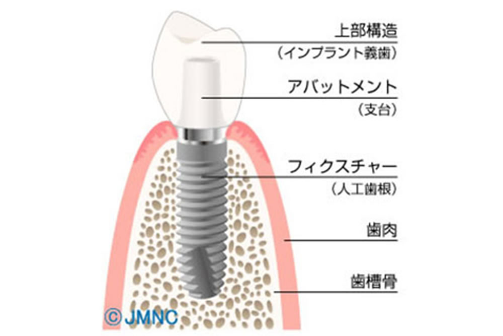 インプラントの構造