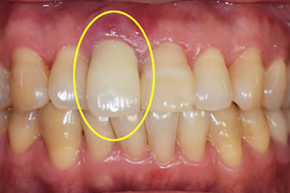 治療例前歯1本欠損