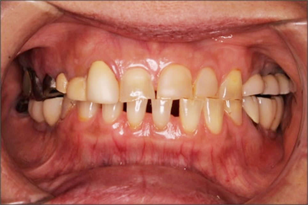 治療例前歯部