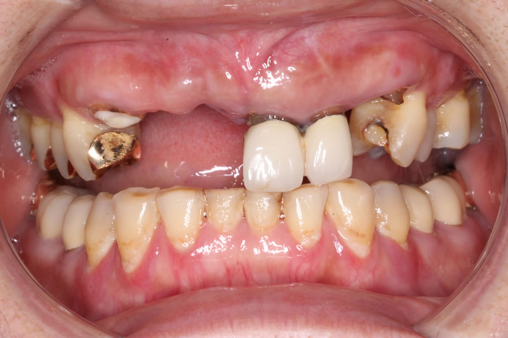 前歯の咬み合わせ回復・審美修復症例