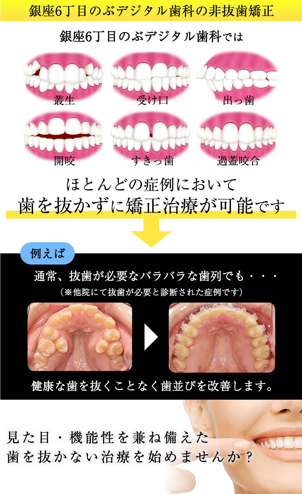 歯 を 抜か ない 矯正 デメリット