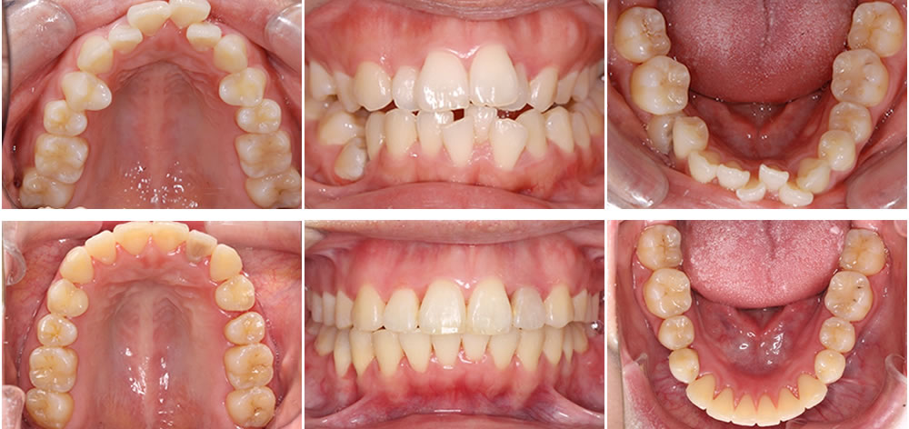 非抜歯矯正の症例